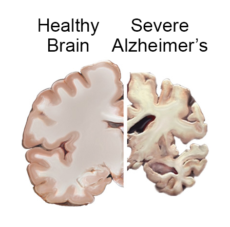 Comparación cerebro normal y afectado por Alzheimer