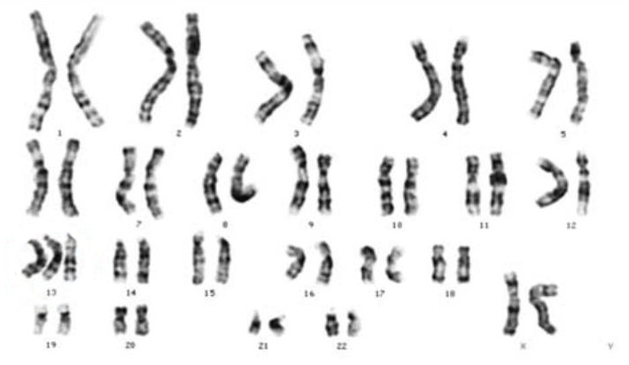 Trisomía del cromosoma 13